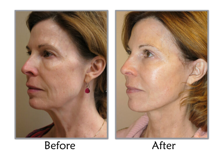 Cosmetic Facelift Surgery Steps To Take Know the steps!!